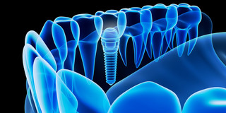 The picture shows a blue colored model of a denture
